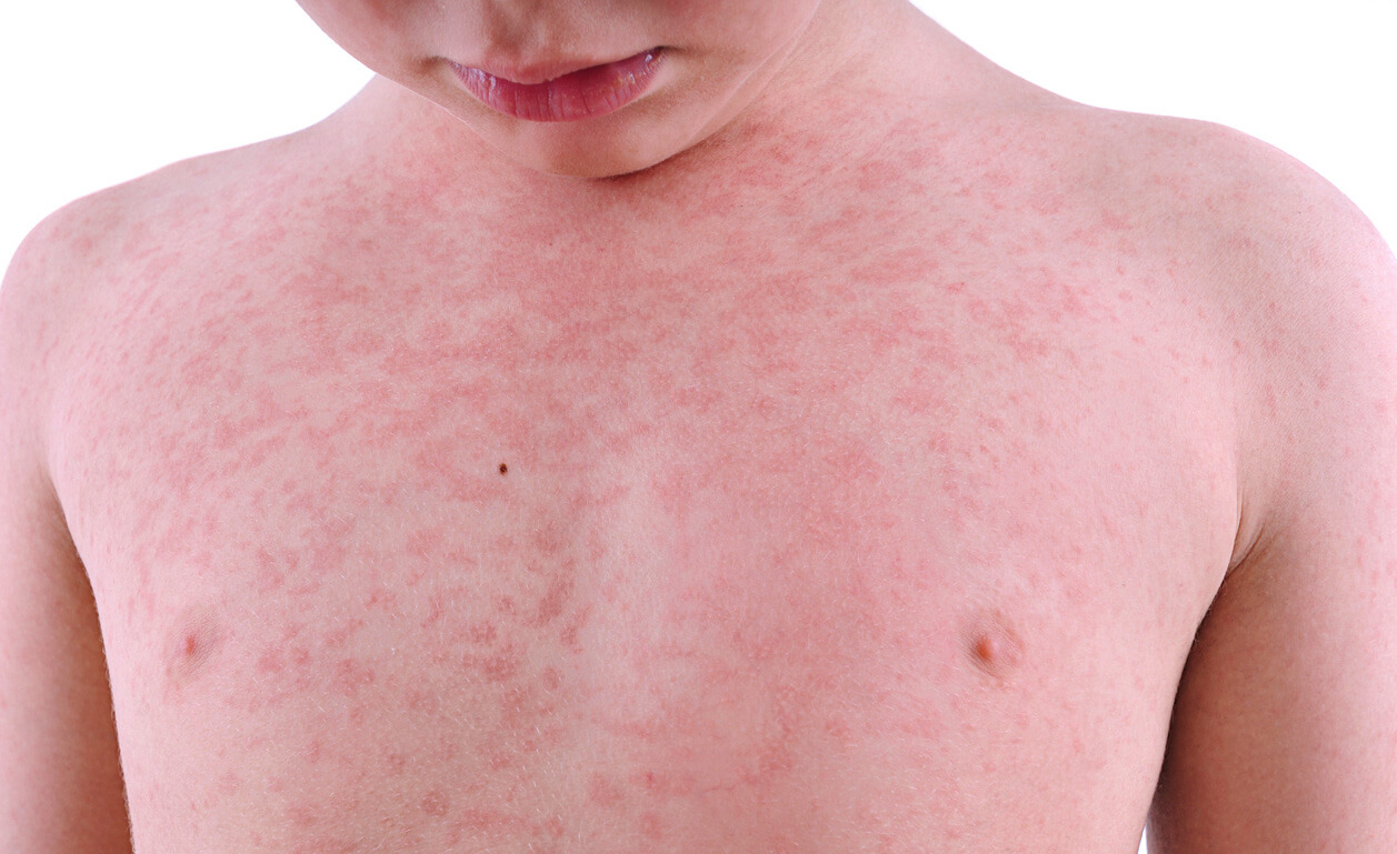 آلرژی و دونه‌های قرمز بر روی  پوست سینه یک کودک 
