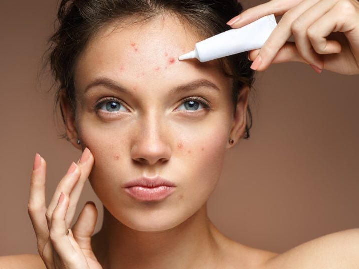 انواع درمان جوش های صورت در مجله اینترنتی مد سارابارا